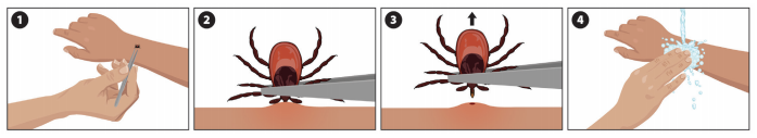 Remove a tick by gripping it with tweezers as close to the skin as possible, pulling upward with steady pressure. After removal, clean the bite area and your hands with sanitizer or soap and water and dispose of the tick by putting it in alcohol, placing it in a sealed bag/container, wrapping it tightly in tape, or flushing it down the toilet.